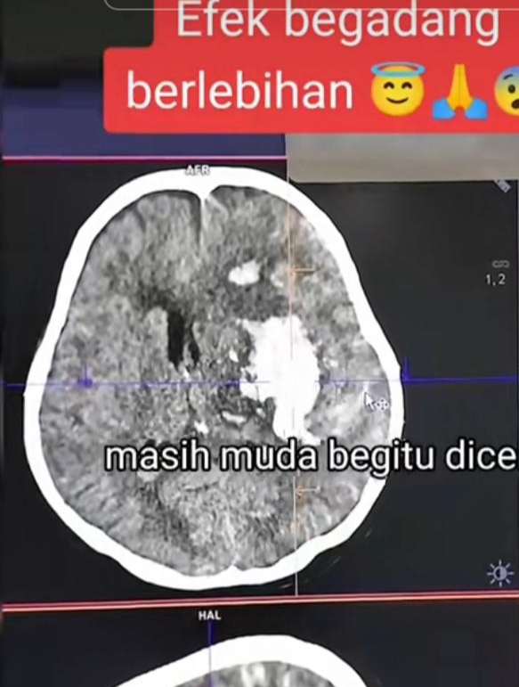 Viral! Gegara Sering Begadang Pasien Alami Pendarahan Otak