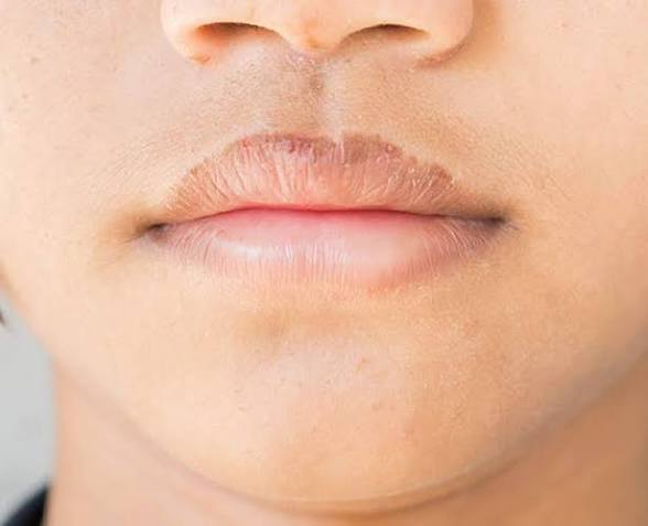 Bibir Hitam Bikin Minder? Ini 6 Solusi Efektif yang Wajib Dicoba