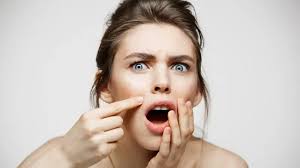 Catat, Ini 10 Tips Alami untuk Menghilangkan Jerawat