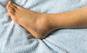 Waspadai! Kaki Bengkak Bisa Terjadi karena Ginjal Rusak, Ini Ciri-cirinya