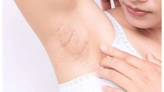 Simak! Begini Cara Ampuh Mengatasi Chicken Skin di Ketiak agar Kamu Kembali Percaya Diri