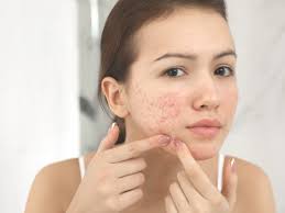 Hindari! 7 Makanan Ini Bisa Bikin Jerawatan saat Dewasa