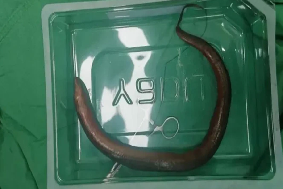 Aneh Bin Ajaib, Seekor Belut Hidup Ditemukan di Rongga Perut Seorang Pria di China