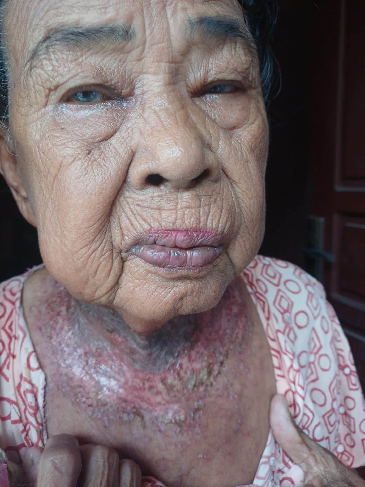 Nenek Tiga Cucu di Ogan Ilir, Terkena Penyakit Kulit Melingkar di Leher
