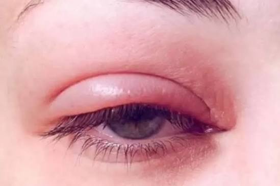 6 Tips Ampuh Mengatasi Kelopak Mata Bengkak