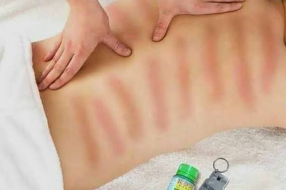 Simak! Ini Manfaat dan Bahaya Kerokan bagi Kesehatan Tubuh