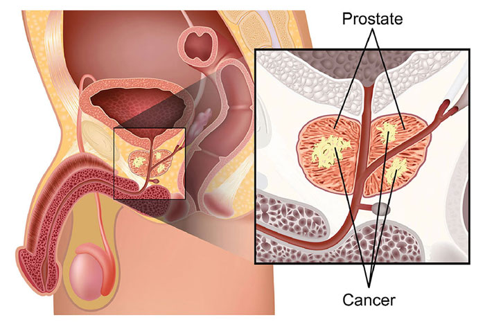 Kanker Prostat Peringkat kelima Penyebab Kematian Pria, Kenali Gejalanya