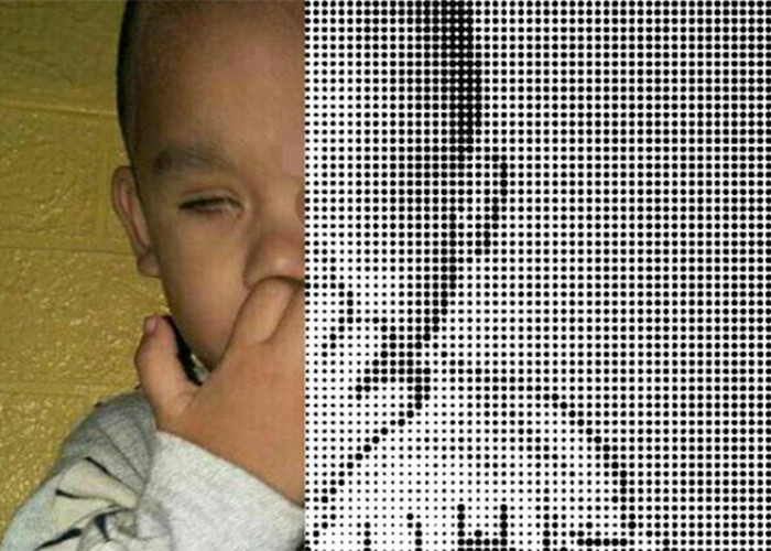 Bocah 2 Tahun Kena Tumor Mata, Sudah Di Bawa Ke RSMH Palembang