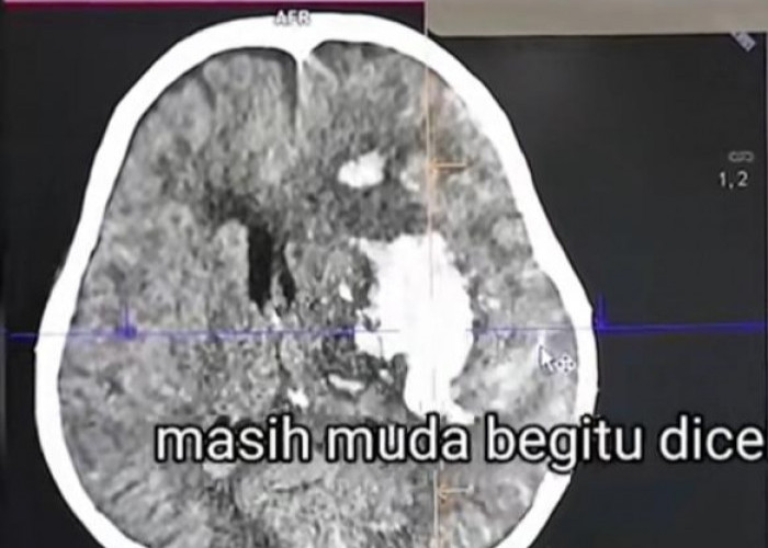 Viral! Gegara Sering Begadang Pasien Alami Pendarahan Otak