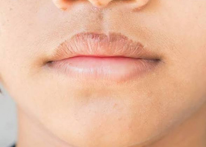 Bibir Hitam Bikin Minder? Ini 6 Solusi Efektif yang Wajib Dicoba