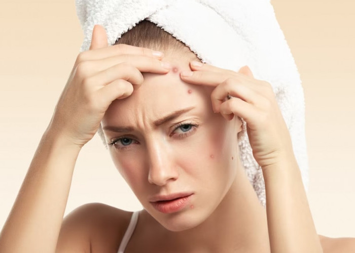 3 Masker Alami untuk Menghilangkan Bekas Jerawat yang Wajib Kamu Coba!