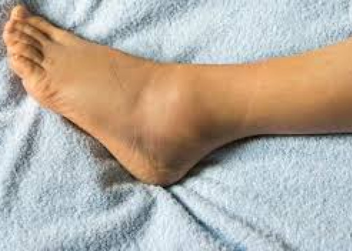 Waspadai! Kaki Bengkak Bisa Terjadi karena Ginjal Rusak, Ini Ciri-cirinya