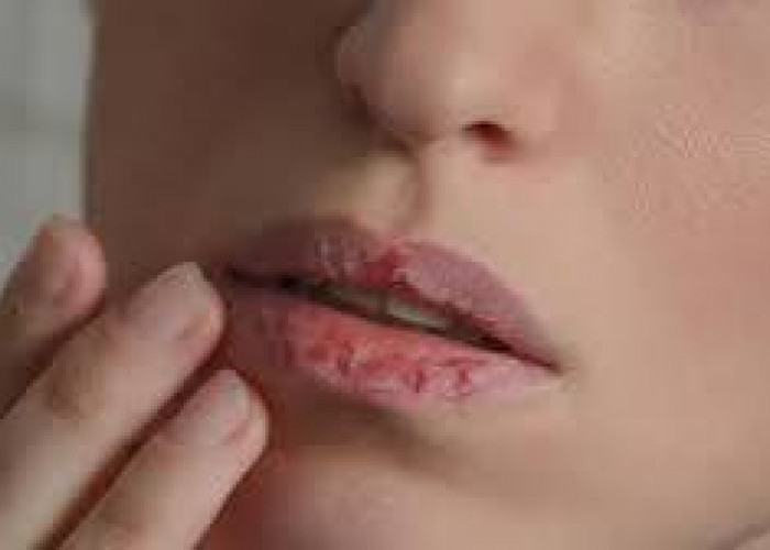 Penyebab dan Cara Mengatasi Bibir Mengelupas