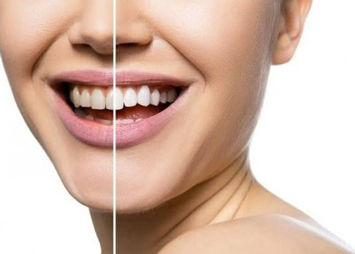 Gigi Kuning Bikin Minder? Ini Tips Aman dan Efektif Mengembalikan Senyum Putih