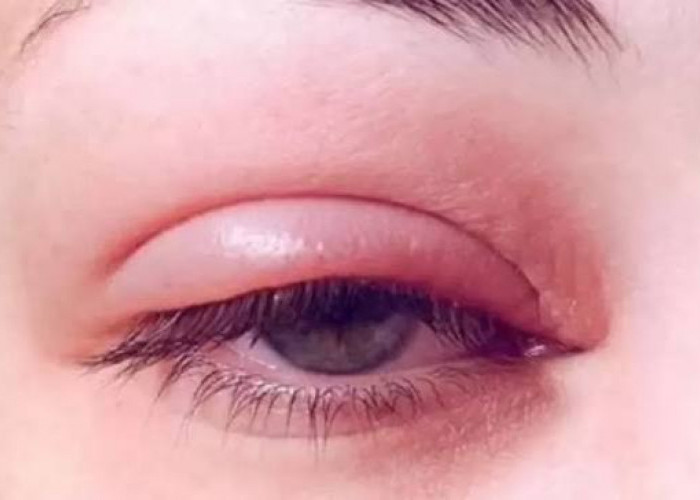 6 Tips Ampuh Mengatasi Kelopak Mata Bengkak