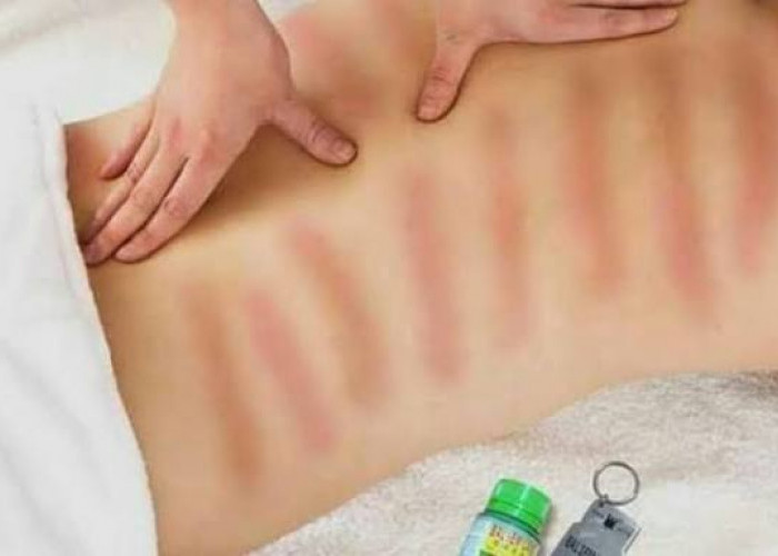 Simak! Ini Manfaat dan Bahaya Kerokan bagi Kesehatan Tubuh