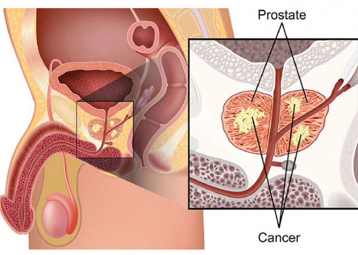 Kanker Prostat Peringkat kelima Penyebab Kematian Pria, Kenali Gejalanya