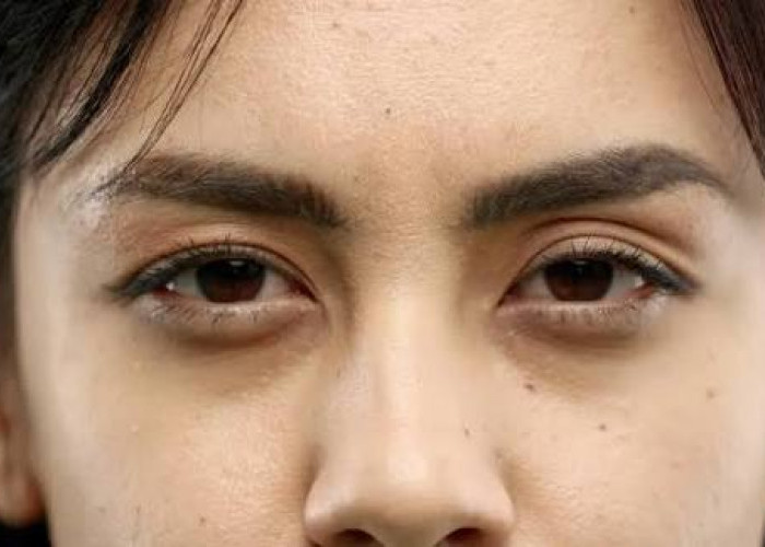 4 Tips Mengatasi Lingkar Hitam pada Mata saat Kurang Tidur di Bulan Ramadan