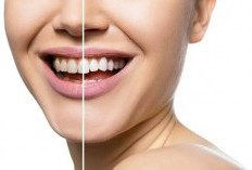 Gigi Kuning Bikin Minder? Ini Tips Aman dan Efektif Mengembalikan Senyum Putih