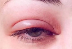 6 Tips Ampuh Mengatasi Kelopak Mata Bengkak