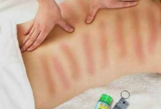 Simak! Ini Manfaat dan Bahaya Kerokan bagi Kesehatan Tubuh